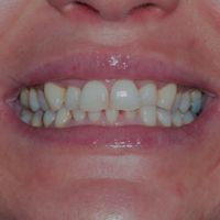 Composite Veneers - Smile 12 before